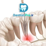 سیستم های کانال ریشه با فناوری نیکل تیتانیوم هوشمند