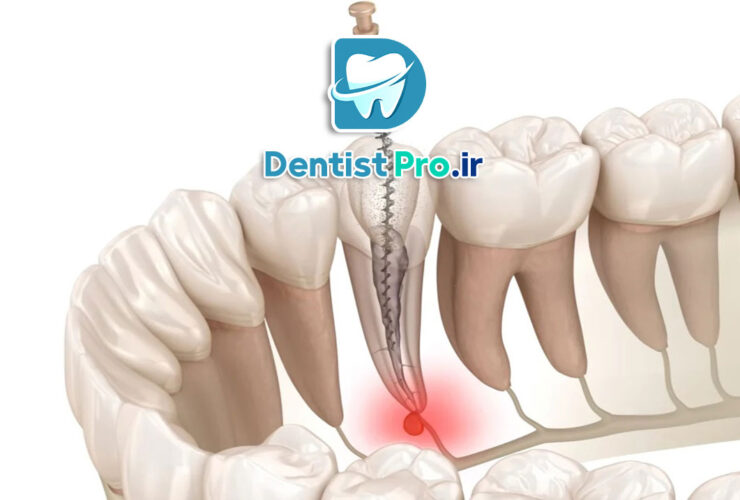 سیستم های کانال ریشه با فناوری نیکل تیتانیوم هوشمند