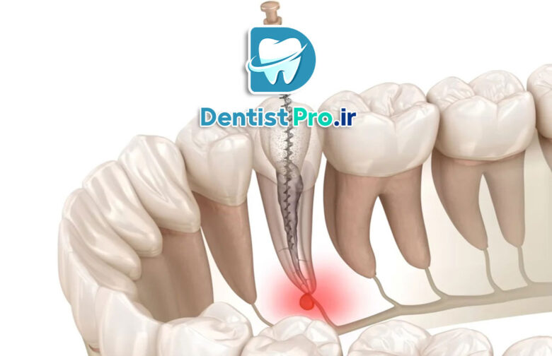 سیستم های کانال ریشه با فناوری نیکل تیتانیوم هوشمند