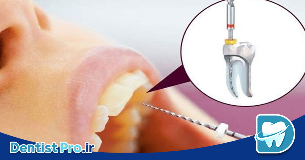 سیستم های کانال ریشه با فناوری نیکل تیتانیوم هوشمند