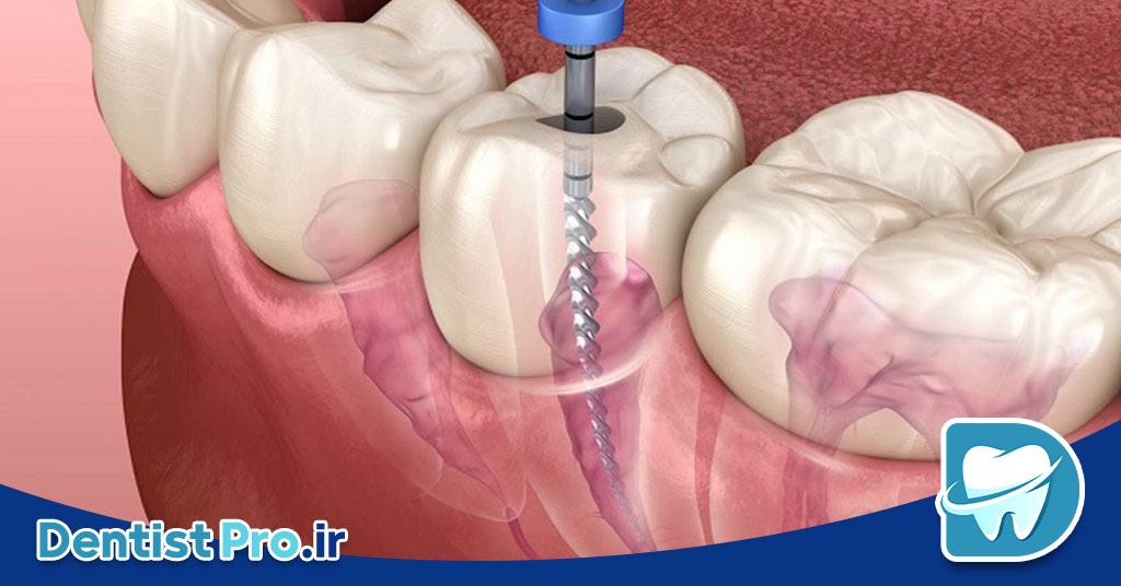 درمان ریشه با میکروسکوپ دندانپزشکی: انقلابی در دندانپزشکی مدرن