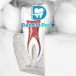 درمان ریشه با میکروسکوپ دندانپزشکی: انقلابی در دندانپزشکی مدرن