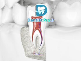 درمان ریشه با میکروسکوپ دندانپزشکی: انقلابی در دندانپزشکی مدرن