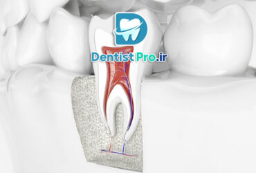درمان ریشه با میکروسکوپ دندانپزشکی: انقلابی در دندانپزشکی مدرن