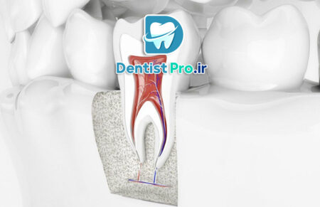 درمان ریشه با میکروسکوپ دندانپزشکی: انقلابی در دندانپزشکی مدرن