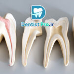 ترمیم ریشه با فیلرهای بیولوژیک نانومتری: نوآوری در درمان‌های اندودنتیک