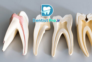 ترمیم ریشه با فیلرهای بیولوژیک نانومتری: نوآوری در درمان‌های اندودنتیک