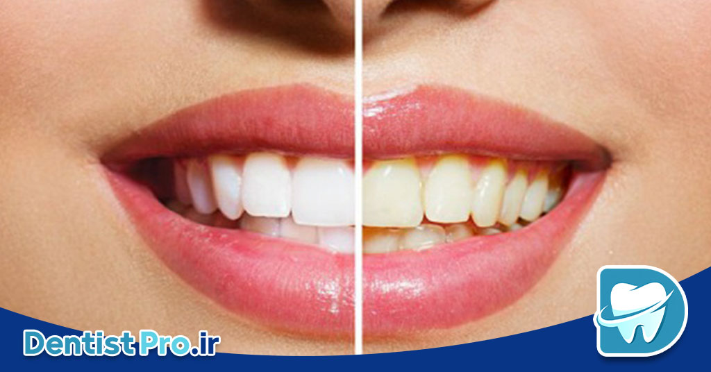 بلیچینگ تخصصی در کلینیک: راهنمای جامع سفید کردن دندانها 26 بلیچینگ تخصصی در کلینیک: راهنمای جامع سفید کردن دندانها