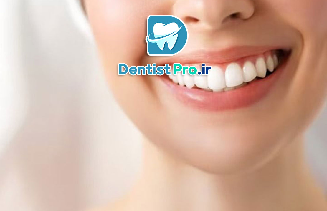 بلیچینگ تخصصی در کلینیک: راهنمای جامع سفید کردن دندانها 25 بلیچینگ تخصصی در کلینیک: راهنمای جامع سفید کردن دندانها