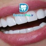 کامپوزیت دندان مقاوم به لک: راهکاری نوین در زیبایی دندان‌ها
