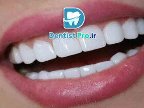 کامپوزیت دندان مقاوم به لک: راهکاری نوین در زیبایی دندان‌ها