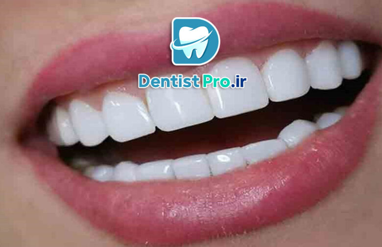 کامپوزیت دندان مقاوم به لک: راهکاری نوین در زیبایی دندان‌ها