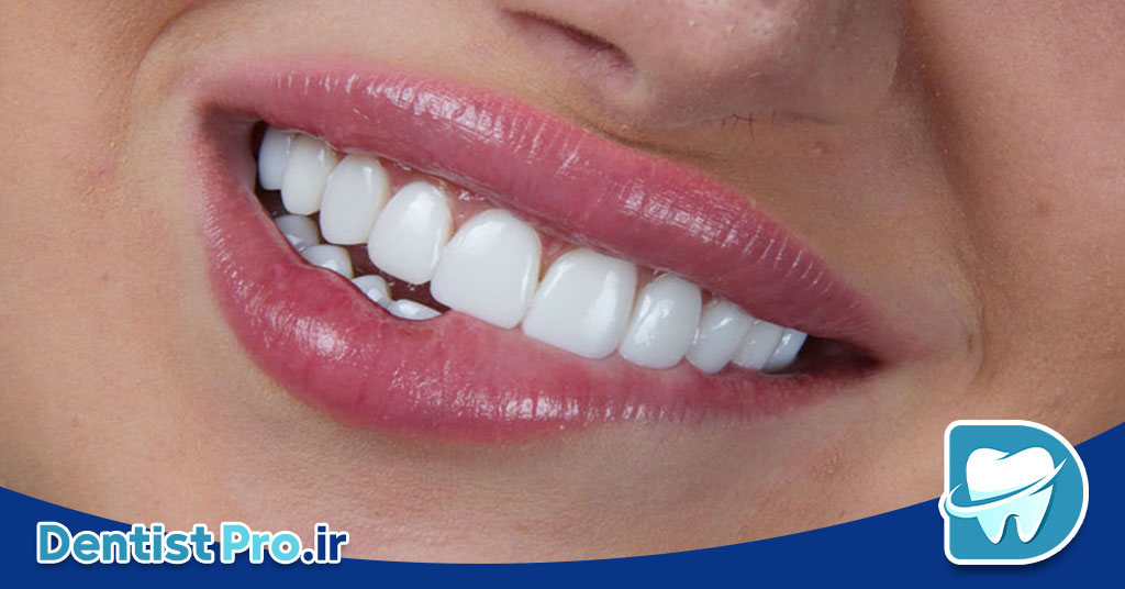 کامپوزیت دندان مقاوم به لک: راهکاری نوین در زیبایی دندان‌ها