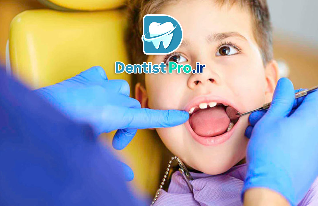 پروتز موقت مخصوص کودکان با دندان از دست رفته: راهکاری کارآمد در دندانپزشکی کودکان