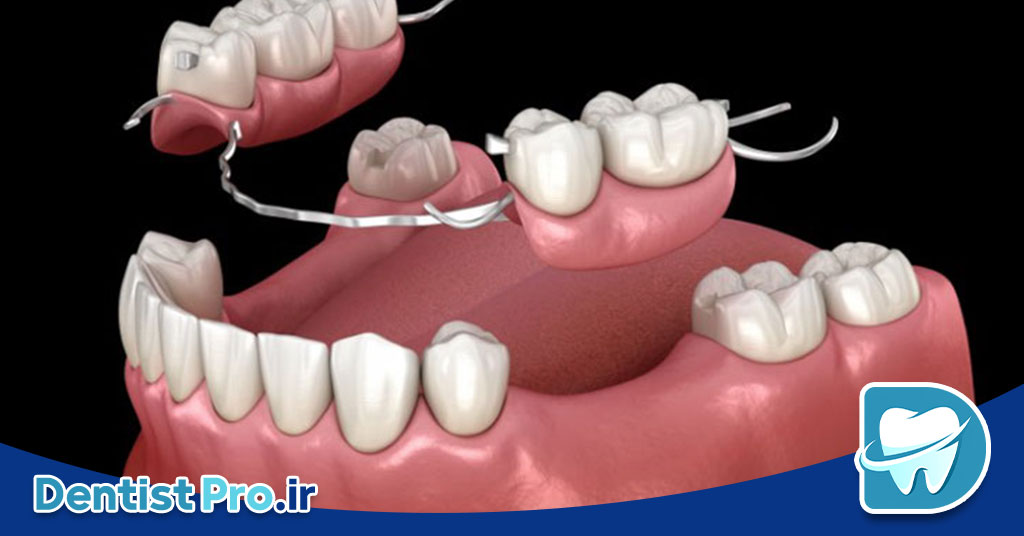 پروتز پارسیل موقت با قالب گیری دیجیتال در کودکان: نوآوری در درمانهای دندانپزشکی کودکان 26 پروتز پارسیل موقت با قالب گیری دیجیتال در کودکان: نوآوری در درمانهای دندانپزشکی کودکان
