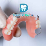 پروتز پارسیل موقت با قالب گیری دیجیتال در کودکان: نوآوری در درمان‌های دندانپزشکی کودکان