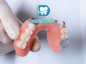 پروتز پارسیل موقت با قالب گیری دیجیتال در کودکان: نوآوری در درمان‌های دندانپزشکی کودکان