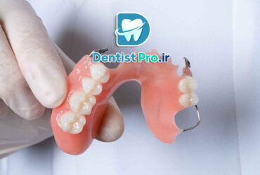 پروتز پارسیل موقت با قالب گیری دیجیتال در کودکان: نوآوری در درمان‌های دندانپزشکی کودکان