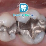 پرکردن همرنگ دندان با تکنولوژی بیس فن: آینده‌ای روشن در ترمیم‌های دندانی