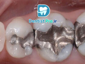 پرکردن همرنگ دندان با تکنولوژی بیس فن: آینده‌ای روشن در ترمیم‌های دندانی