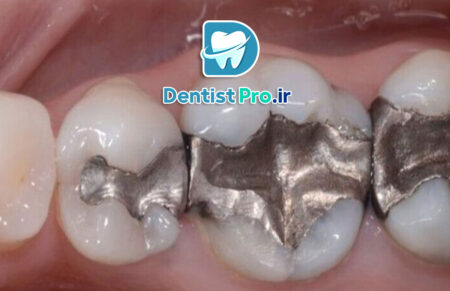 پرکردن همرنگ دندان با تکنولوژی بیس فن: آینده‌ای روشن در ترمیم‌های دندانی