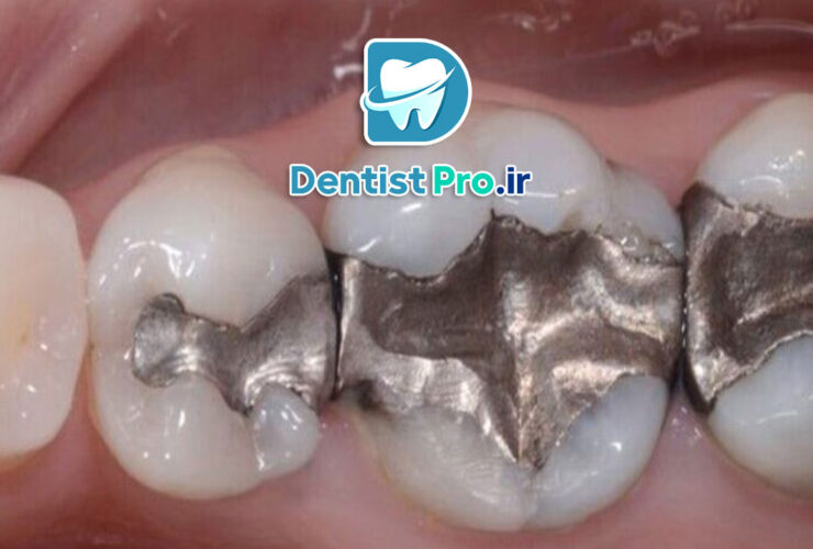 پرکردن همرنگ دندان با تکنولوژی بیس فن: آینده‌ای روشن در ترمیم‌های دندانی