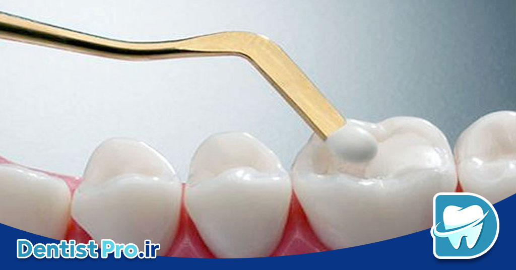 پرکردن همرنگ دندان با تکنولوژی بیس فن: آینده‌ای روشن در ترمیم‌های دندانی