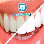 تغییر رنگ مینای دندان+0 تا 100 موارد علمی