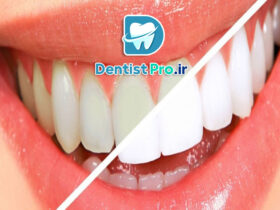 تغییر رنگ مینای دندان+0 تا 100 موارد علمی