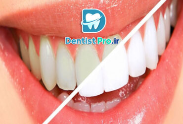 تغییر رنگ مینای دندان+0 تا 100 موارد علمی