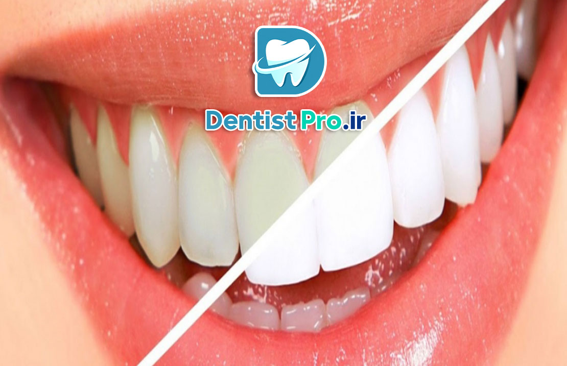 تغییر رنگ مینای دندان+0 تا 100 موارد علمی
