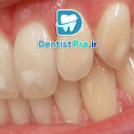 میکرودرمابراسیون مینای دندان: روشی نوین برای زیبایی و سلامت دندان‌ها