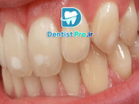 میکرودرمابراسیون مینای دندان: روشی نوین برای زیبایی و سلامت دندان‌ها