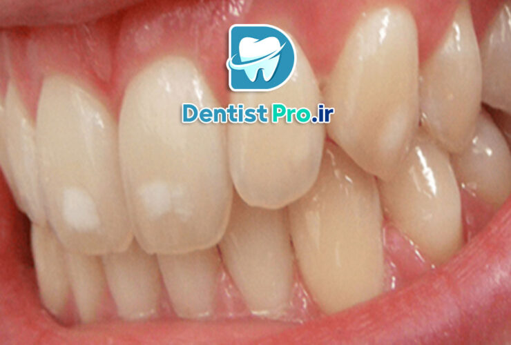 میکرودرمابراسیون مینای دندان: روشی نوین برای زیبایی و سلامت دندان‌ها