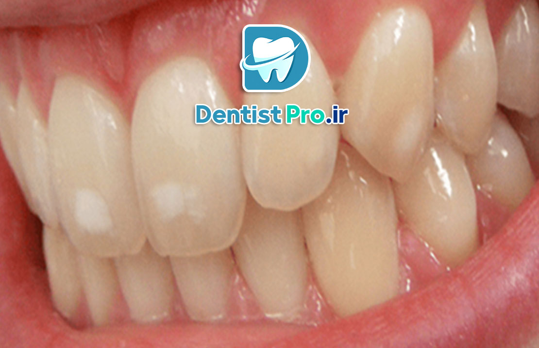 میکرودرمابراسیون مینای دندان: روشی نوین برای زیبایی و سلامت دندان‌ها