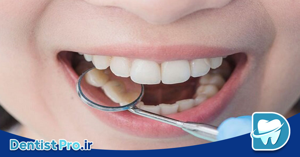 میکرودرمابراسیون مینای دندان: روشی نوین برای زیبایی و سلامت دندان‌ها