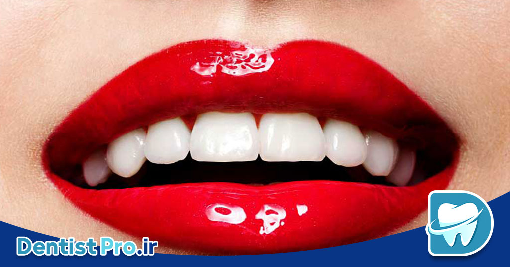 اصلاح شکل دندان با اورلپ لمینت چگونه است؟ 26 اصلاح شکل دندان با اورلپ لمینت چگونه است؟