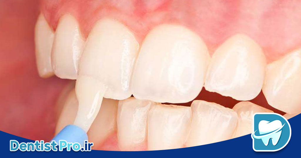 فلوراید تراپی موضعی با ژل فلوراید NaF: راهکاری موثر برای پیشگیری از پوسیدگی دندان 26 فلوراید تراپی موضعی با ژل فلوراید NaF: راهکاری موثر برای پیشگیری از پوسیدگی دندان