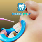 فلوراید تراپی موضعی با ژل فلوراید NaF: راهکاری موثر برای پیشگیری از پوسیدگی دندان