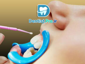 فلوراید تراپی موضعی با ژل فلوراید NaF: راهکاری موثر برای پیشگیری از پوسیدگی دندان