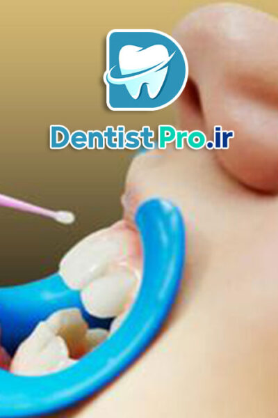 فلوراید تراپی موضعی با ژل فلوراید NaF: راهکاری موثر برای پیشگیری از پوسیدگی دندان