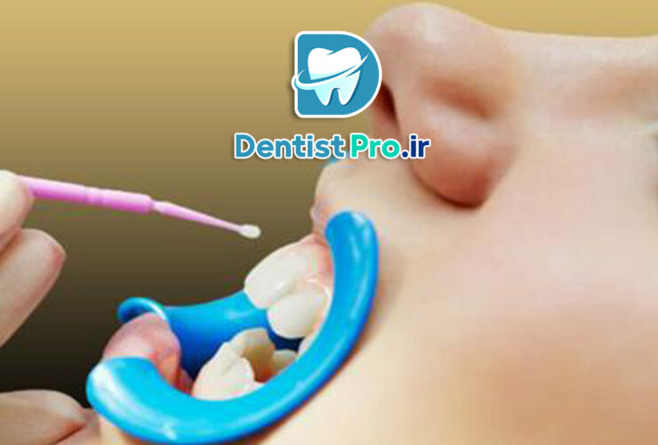 فلوراید تراپی موضعی با ژل فلوراید NaF: راهکاری موثر برای پیشگیری از پوسیدگی دندان 39 فلوراید تراپی موضعی با ژل فلوراید NaF: راهکاری موثر برای پیشگیری از پوسیدگی دندان