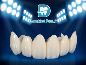 روکش زیرکونیوم شفاف: تحولی در دندانپزشکی زیبایی