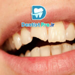 درمان شکستگی دندان جلو با مواد کامپوزیت: راهکاری سریع، موثر و زیبا