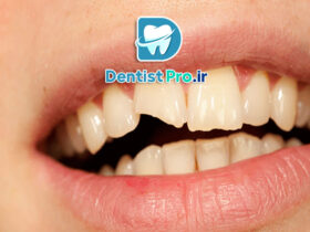 درمان شکستگی دندان جلو با مواد کامپوزیت: راهکاری سریع، موثر و زیبا