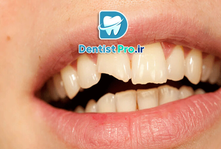 درمان شکستگی دندان جلو با مواد کامپوزیت: راهکاری سریع، موثر و زیبا 27 درمان شکستگی دندان جلو با مواد کامپوزیت: راهکاری سریع، موثر و زیبا