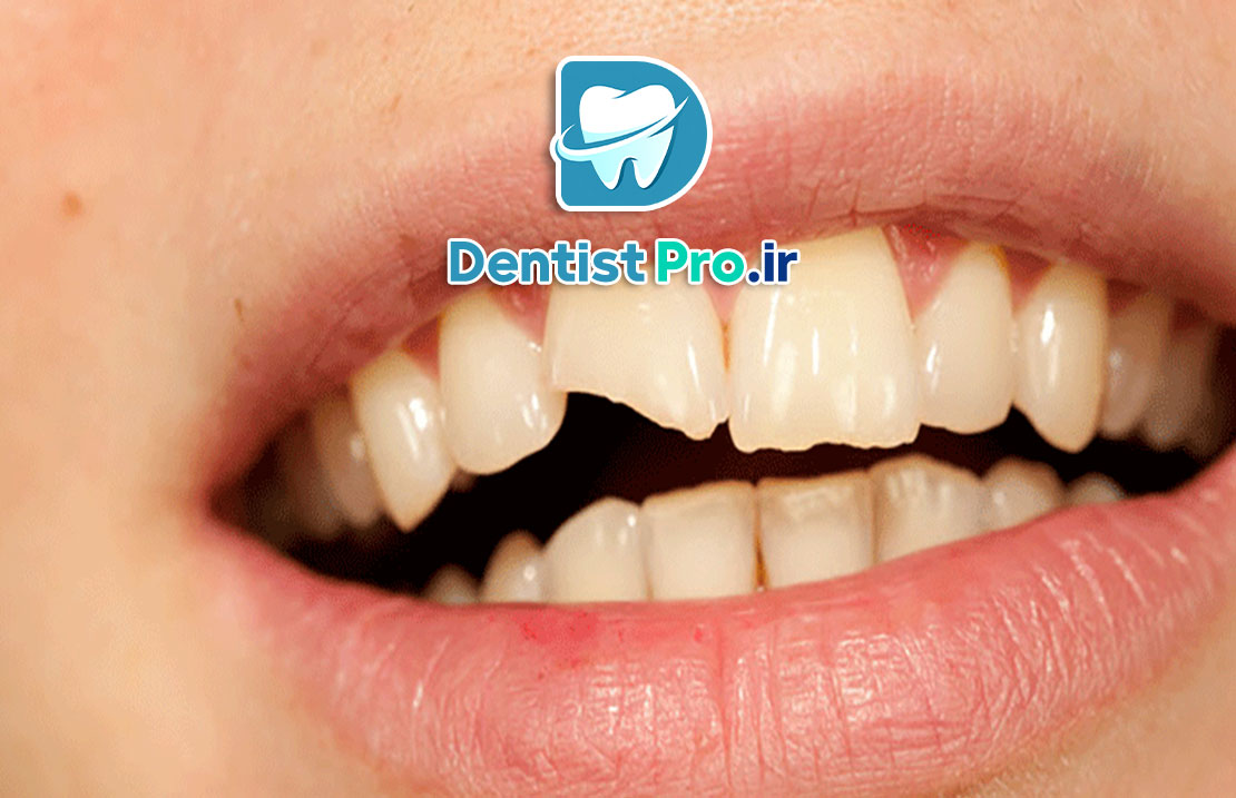 درمان شکستگی دندان جلو با مواد کامپوزیت: راهکاری سریع، موثر و زیبا
