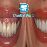 درمان التهاب لثه با لیزر پرتوان: راهنمای کامل