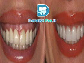 درمان التهاب لثه با لیزر پرتوان: راهنمای کامل