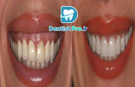 درمان التهاب لثه با لیزر پرتوان: راهنمای کامل